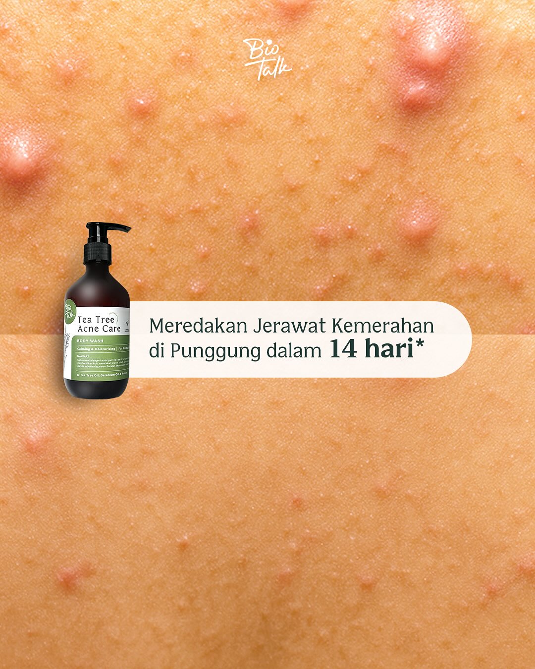 Pernah ngerasa jerawat kamu di punggung gatal dan bikin commute gak nyaman 😢Kamu nggak sendiria (2)